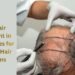 Best Hair Transplant in Los Angeles for Thinning Hair Solutions 1
