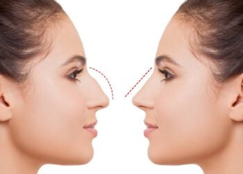 Rhinoplasty