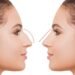 Rhinoplasty