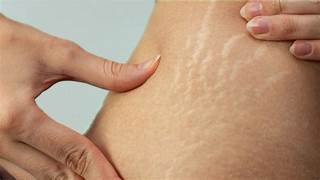Stretch marks