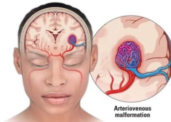 What is a Brain AVM