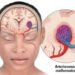 What is a Brain AVM