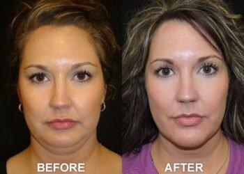chin botox before and after5