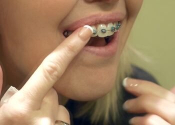 Discreet Smile Transformation: Invisible Braces Treatment Options maxresdefault 7