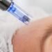 what can microneedling do