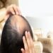 Hair Loss Treatment in Riyadh