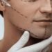 Jawline Surgery In Islamabad