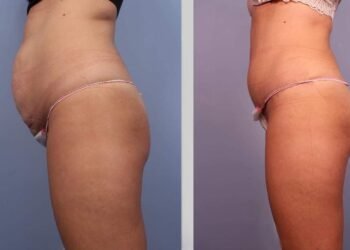 Liposuction in Islamabad