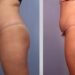 Liposuction in Islamabad