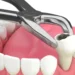 Professional Tooth Removal for Better Oral Health Tooth Extraction