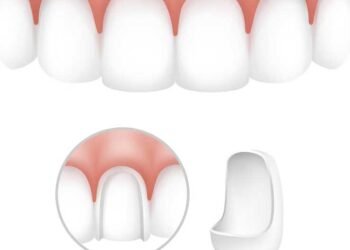 Veneers in Dubai: Who Can Benefit and How It Works dental veneers 2