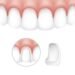 dental veneers 2