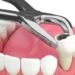 socket after teeth