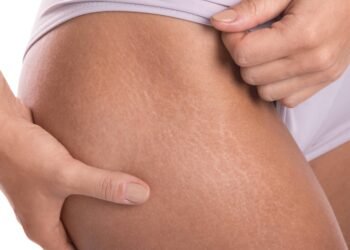 stretch marks smol