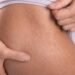 stretch marks smol
