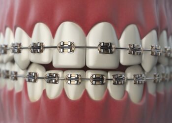 Braces for Teeth