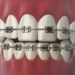Braces for Teeth
