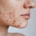 Acne treatment
