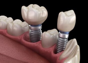 Dental Implants and Dentures