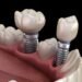 Dental Implants and Dentures