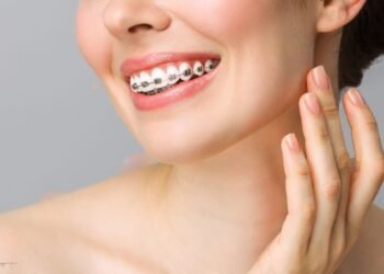 Teeth Braces in Dubai