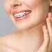 Teeth Braces in Dubai