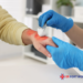 burns treatment