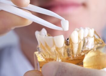dental implants