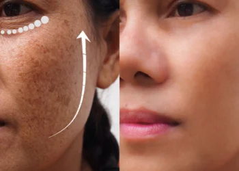 Can Kojic Acid Help With Dark Spots and Hyperpigmentation? image before and after anti aging dark spot 1024x1024 1